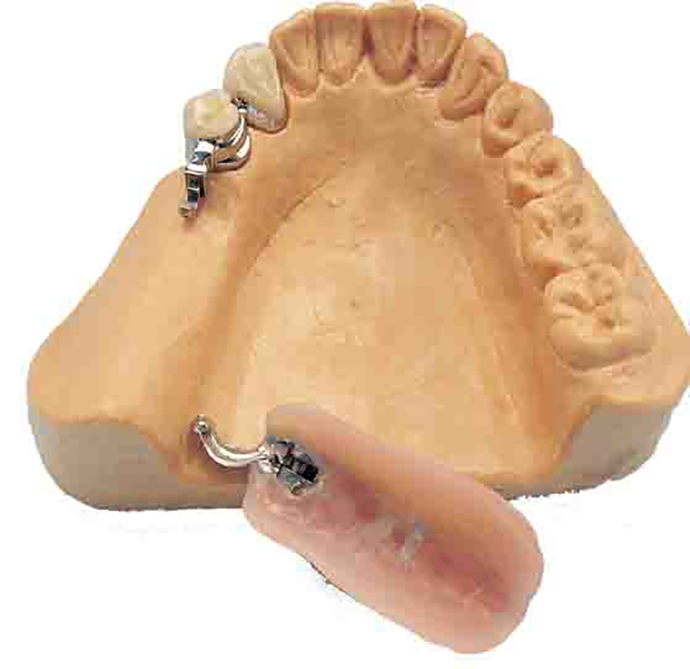 PRECISION ATTACHMENT ByDental